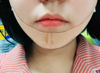 아이디플라코스메틱 아이디 페이스핏 마이너스 밴드 — 4점을 준 리뷰어가 2019년 11월 올린 사용 사진