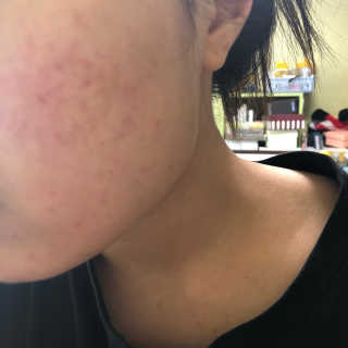 보타니티 [홍]조[진]정[결]케어 플라본 세럼 — 4.33점을 준 리뷰어가 2018년 5월 올린 사용 사진