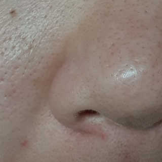 메디필 블랙 허니 세범 익스트렉터 — 5점을 준 리뷰어가 2020년 6월 올린 사용 사진