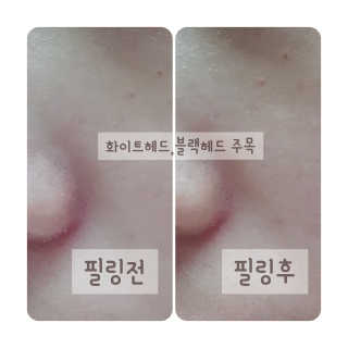 브라운랩 페이셜 필링 스왑 키트 2ea — 5점을 준 리뷰어가 2020년 5월 올린 사용 사진