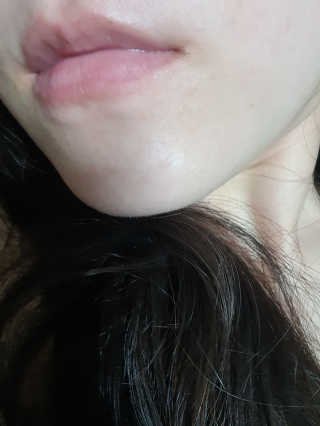 엘라밴드 하이드로 도트 스팟패치 12mm, 티트리 — 4점을 준 리뷰어가 2020년 8월 올린 사용 사진