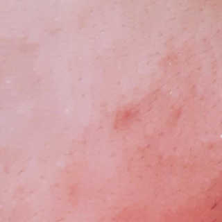 엘라밴드 하이드로 도트 스팟패치 12mm, 10mm — 5점을 준 리뷰어가 2020년 8월 올린 사용 사진