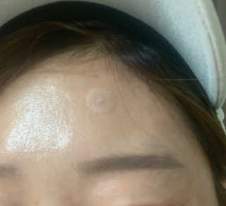엘라밴드 하이드로 도트 스팟패치 12mm, 10mm — 4.5점을 준 리뷰어가 2020년 9월 올린 사용 사진