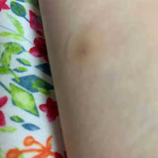 엘라밴드 하이드로 도트 스팟패치 12mm, 10mm — 5점을 준 리뷰어가 2020년 10월 올린 사용 사진