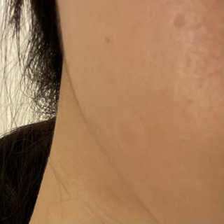 엘라밴드 하이드로 도트 스팟패치 12mm, 10mm — 5점을 준 리뷰어가 2020년 10월 올린 사용 사진