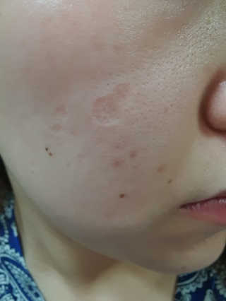 derma SC-Gel 더마에스씨 겔 20g — 5점을 준 리뷰어가 2020년 5월 올린 사용 사진