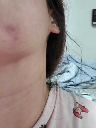 엘라밴드 하이드로 도트 스팟패치 12mm, 10mm — 4점을 준 리뷰어가 2020년 8월 올린 사용 사진