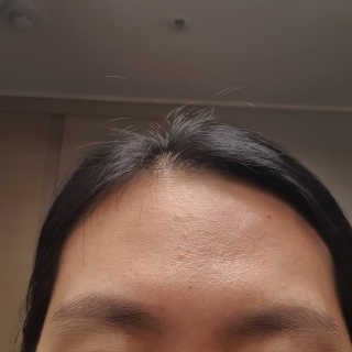 엘라밴드 하이드로 도트 스팟패치 12mm, 티트리 — 5점을 준 리뷰어가 2020년 9월 올린 사용 사진