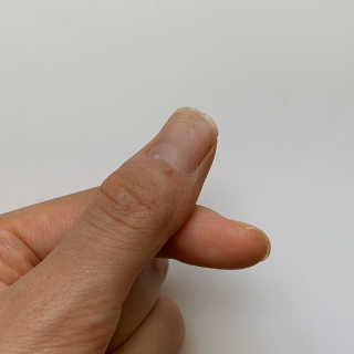 엘라밴드 하이드로 도트 스팟패치 12mm, 10mm — 5점을 준 리뷰어가 2020년 9월 올린 사용 사진