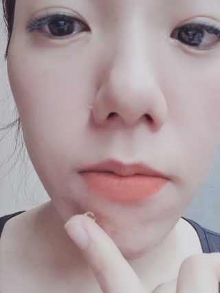 히루스카 포스트아크네 클리어 — 4점을 준 리뷰어가 2020년 12월 올린 사용 사진