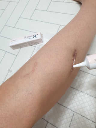derma SC-Gel 더마에스씨 겔 20g — 5점을 준 리뷰어가 2020년 5월 올린 사용 사진