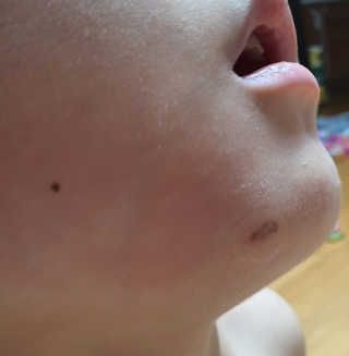 엘라밴드 하이드로 도트 스팟패치 12mm, 티트리 — 5점을 준 리뷰어가 2020년 8월 올린 사용 사진