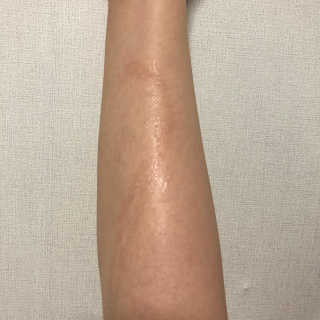 derma SC-Gel 더마에스씨 겔 20g — 5점을 준 리뷰어가 2020년 5월 올린 사용 사진