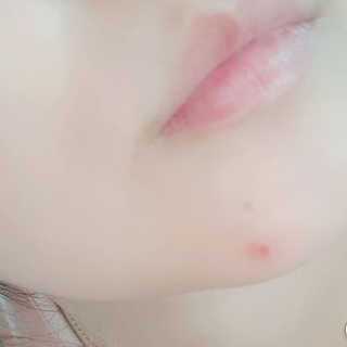 엘라밴드 하이드로 도트 스팟패치 12mm, 10mm — 5점을 준 리뷰어가 2020년 11월 올린 사용 사진