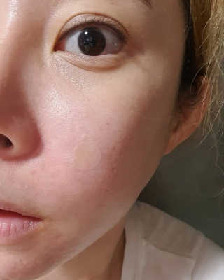 엘라밴드 하이드로 도트 스팟패치 12mm, 10mm — 4.5점을 준 리뷰어가 2020년 8월 올린 사용 사진
