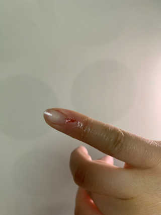 derma SC-Gel 더마에스씨 겔 20g — 5점을 준 리뷰어가 2020년 4월 올린 사용 사진