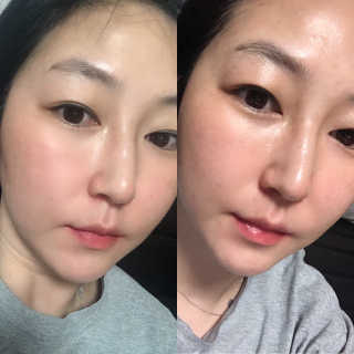 메디힐 텐션 플렉스 마스크 2종 — 4점을 준 리뷰어가 2020년 4월 올린 사용 사진
