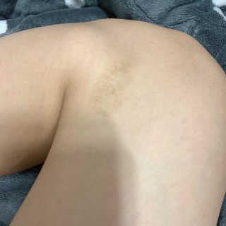derma SC-Gel 더마에스씨 겔 20g — 4점을 준 리뷰어가 2020년 5월 올린 사용 사진