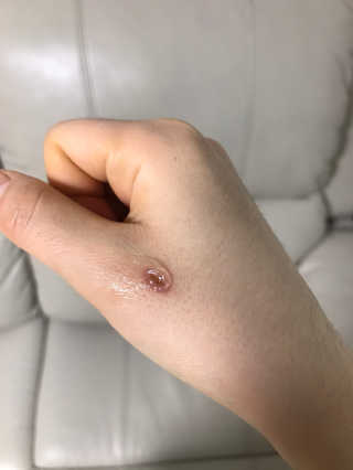 derma SC-Gel 더마에스씨 겔 20g — 4.5점을 준 리뷰어가 2020년 4월 올린 사용 사진