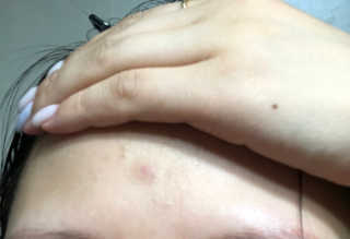 엘라밴드 하이드로 도트 스팟패치 12mm, 10mm — 5점을 준 리뷰어가 2020년 8월 올린 사용 사진
