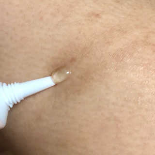 derma SC-Gel 더마에스씨 겔 20g — 4.5점을 준 리뷰어가 2020년 4월 올린 사용 사진
