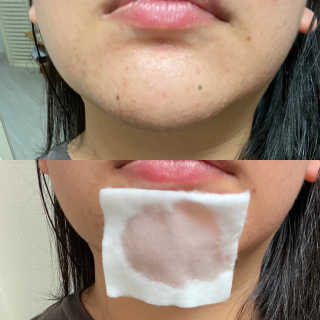 메디필 블랙 허니 세범 익스트렉터 — 4점을 준 리뷰어가 2020년 6월 올린 사용 사진