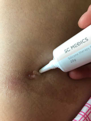 derma SC-Gel 더마에스씨 겔 20g — 4.5점을 준 리뷰어가 2020년 4월 올린 사용 사진