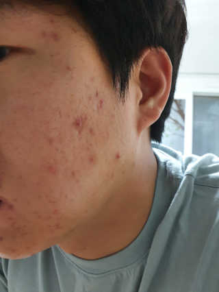 니들리 안티스팟 딥 브라이트닝 풀 키트 — 4점을 준 리뷰어가 2020년 4월 올린 사용 사진