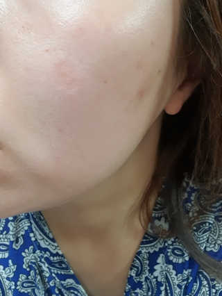 derma SC-Gel 더마에스씨 겔 20g — 5점을 준 리뷰어가 2020년 5월 올린 사용 사진