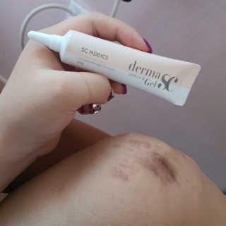 derma SC-Gel 더마에스씨 겔 20g — 5점을 준 리뷰어가 2020년 5월 올린 사용 사진