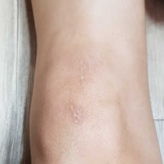 derma SC-Gel 더마에스씨 겔 20g — 5점을 준 리뷰어가 2020년 5월 올린 사용 사진
