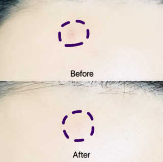 derma SC-Gel 더마에스씨 겔 20g — 5점을 준 리뷰어가 2020년 5월 올린 사용 사진