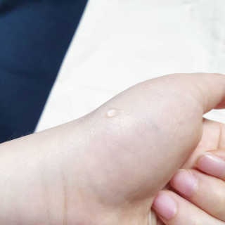 derma SC-Gel 더마에스씨 겔 20g — 5점을 준 리뷰어가 2020년 4월 올린 사용 사진