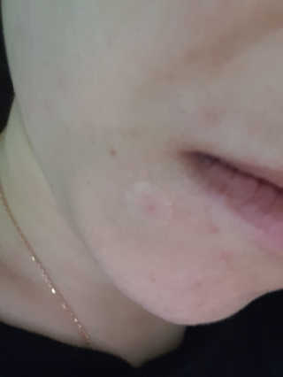 엘라밴드 하이드로 도트 스팟패치 12mm, 10mm — 5점을 준 리뷰어가 2020년 8월 올린 사용 사진