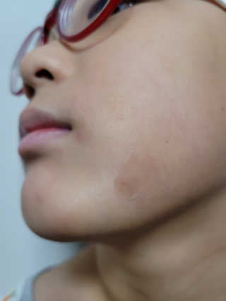 엘라밴드 하이드로 도트 스팟패치 12mm, 10mm — 5점을 준 리뷰어가 2020년 9월 올린 사용 사진
