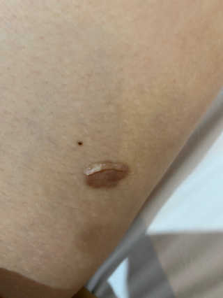derma SC-Gel 더마에스씨 겔 20g — 4점을 준 리뷰어가 2020년 5월 올린 사용 사진