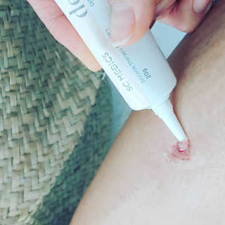 derma SC-Gel 더마에스씨 겔 20g — 5점을 준 리뷰어가 2020년 5월 올린 사용 사진