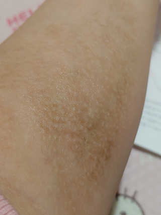 derma SC-Gel 더마에스씨 겔 20g — 5점을 준 리뷰어가 2020년 5월 올린 사용 사진