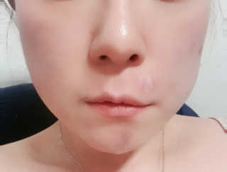 엘라밴드 하이드로 도트 스팟패치 12mm, 티트리 — 5점을 준 리뷰어가 2020년 9월 올린 사용 사진