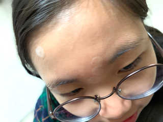 엘라밴드 하이드로 도트 스팟패치 12mm, 10mm — 5점을 준 리뷰어가 2020년 10월 올린 사용 사진