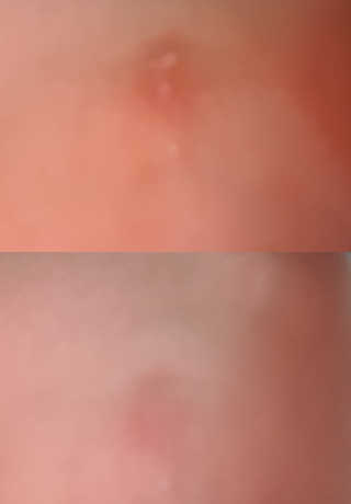 derma SC-Gel 더마에스씨 겔 20g — 5점을 준 리뷰어가 2020년 5월 올린 사용 사진