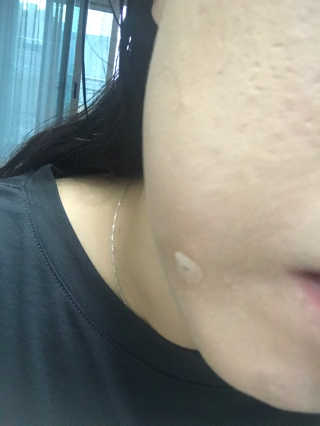 엘라밴드 하이드로 도트 스팟패치 12mm, 티트리 — 1.5점을 준 리뷰어가 2020년 8월 올린 사용 사진