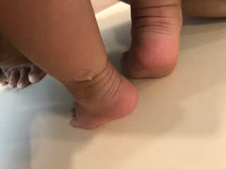 엘라밴드 하이드로 도트 스팟패치 12mm, 10mm — 5점을 준 리뷰어가 2020년 8월 올린 사용 사진