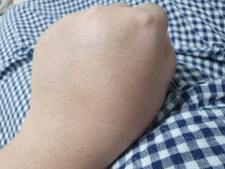 엘라밴드 하이드로 도트 스팟패치 12mm, 10mm — 5점을 준 리뷰어가 2020년 9월 올린 사용 사진