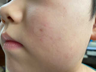 엘라밴드 하이드로 도트 스팟패치 12mm, 10mm — 5점을 준 리뷰어가 2020년 8월 올린 사용 사진