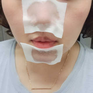 메디필 블랙 허니 세범 익스트렉터 — 3점을 준 리뷰어가 2020년 6월 올린 사용 사진