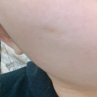 엘라밴드 하이드로 도트 스팟패치 12mm, 10mm — 5점을 준 리뷰어가 2020년 10월 올린 사용 사진