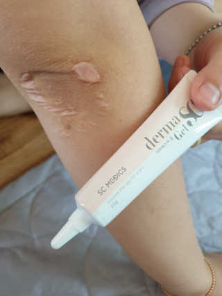 derma SC-Gel 더마에스씨 겔 20g — 5점을 준 리뷰어가 2020년 4월 올린 사용 사진