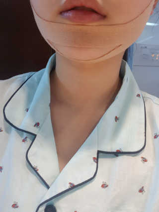 아이디플라코스메틱 아이디 페이스핏 마이너스 밴드 — 4점을 준 리뷰어가 2020년 4월 올린 사용 사진
