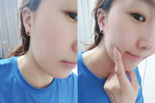 엘라밴드 하이드로 도트 스팟패치 12mm, 10mm — 4.5점을 준 리뷰어가 2020년 10월 올린 사용 사진